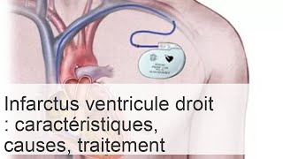 Infarctus du ventricule droit  symptômes traitement et prévention [upl. by Grannie]