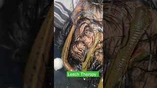 Leech sulking hairregrowth shortvideo ayurveda panchkarma agnikarma shortvideo shorts [upl. by Alleuqram420]