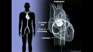 Coronary Arteriography  Coronary Angiography  Definition Procedure Uses Benefits [upl. by Lucais]