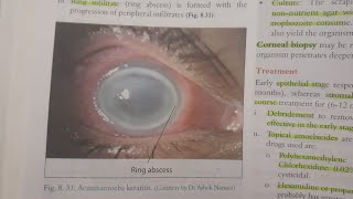 Acanthamoeba Keratitis  EYE [upl. by Atiuqiram]