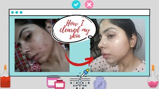 ✅5 SKINCARE PRODUCTS That Actually Work On PIGMENTATION UNEVEN SKIN TONE amp DARK SPOTS [upl. by Idid124]