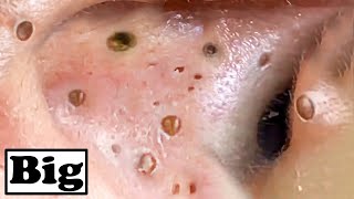 Super Removal Blackheads In Ear [upl. by Ahsenar169]