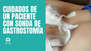 Cuidados de paciente con sonda de gastrostomía [upl. by Cynthea356]