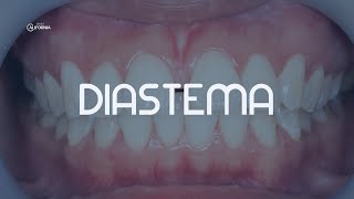 DIASTEMA  DENTAL CALIFORNIA [upl. by Quirita854]