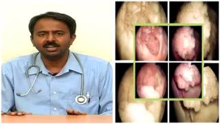 Doctor care  Bladder Cancer Symptoms And Treatment Part 1 [upl. by Jb]