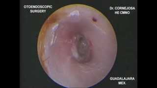 EXPLORACIÓN ENDOSCÓPICA DE MEMBRANA TIMPÁNICA PERFORADA Dr Cornejosa [upl. by Teik]