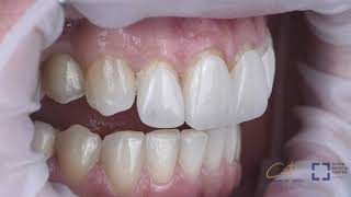 BEAUTIFUL VENEERS DELIVERED UNDER RUBBER DAM ISOLATION [upl. by Rafaela]