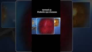 Can I have Glaucoma from diabetes？ [upl. by Javier]