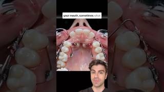 Amazing Timelapse Fixing Impacted Teeth [upl. by Mccreery613]