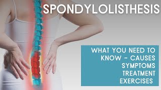 What you need to know about SPONDYLOLISTHESIS causes symptoms treatment exercises [upl. by Odlanra159]