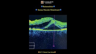 Retinoschisis Serous Macular Detachment [upl. by Risteau]