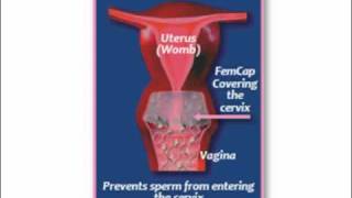 What is the FemCap Cervical Cap [upl. by Carmelina]