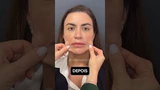 RESULTADO PROTOCOLLBIORECONEXÃO hof rejuvenescimentofacial bioestimuladordecolageno peeling [upl. by Zosima858]