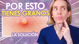 5 RAZONES por las cuales TE SALEN GRANITOS  Como SOLUCIONARLAS  Simon Scarano Dermatologo [upl. by Terrence]