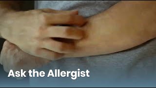 Chronic Hives Triggers and Treatment Ask the Allergist Chronic Urticaria [upl. by Rother312]