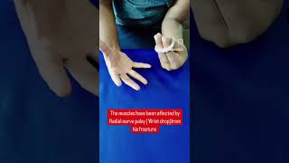 Radial nerve palsyShaft of humerus fractureWrist dropHome exercises for wrist dropstrengthening [upl. by Eiramaliehs]