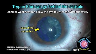 CataractCoach™ 1992 trypan blue can go behind the capsule [upl. by Gaudet]