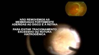 Cirurgia Limitada em Retinopatia Diabética [upl. by Ahseila]