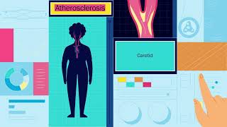 How Well Do You Know Your Heart Part 2 Symptoms of Atherosclerosis [upl. by Ahgem]