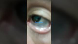 Unveiling the Mystery of Blue Sclera [upl. by Lerrad]