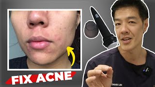 Getting Rid of Acne Scars at Home  Microneedling  Dr Davin Lim [upl. by Athiste970]