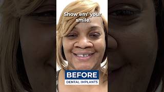 How She Afforded Dental Implants On A Budget 💰🦷 [upl. by Venable464]