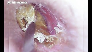 Ear Wax Removal 101 Itching Like Crazy Because Of Big And Thick Earwax  Ear Cleaning ASMR [upl. by Tarrel]