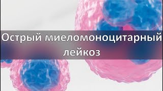 Острый миеломоноцитарный лейкоз [upl. by Mendie]