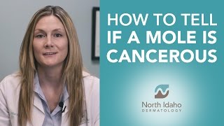 How to Tell if Your Mole is Cancerous  North Idaho Dermatology [upl. by Eibbed]