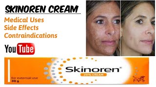 Skinoren Cream  Medical Uses  Face Whitening Agent [upl. by Quintilla184]