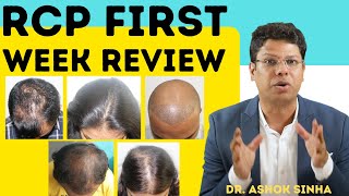 INNOVATIVE HAIR TREATMENT BY ADON  NEXT 5 TESTING PATIENTS   Dr ASHOK SINHA [upl. by Lilllie792]