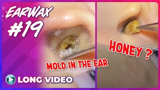 EP 19 Earwax ASMR Remove earwax from ears infected with fungus and yellow pus discharge [upl. by Nnire]