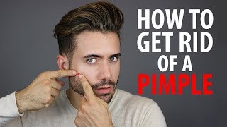 How To Get Rid of a Pimple Overnight  Fast Pimple and Acne Treatments  Alex Costa [upl. by Jo Ann]