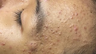 ACNE TREATMENT VU QUYNH MI  Blackheads Chin amp Nose Of Teen 2024 [upl. by Wesle]