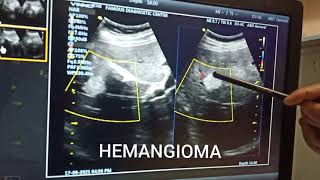 Liver hemangiomaHepatic hemangioma vascular tumor in liver Benign tumor in liver [upl. by Edahc]