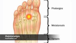 Metatarsalgia Foot Pain Causes Symptoms amp Treatments [upl. by Dumanian268]