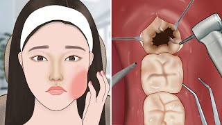 ASMR Satisfying Wisdom tooth removal  Dental care animation [upl. by Nidnarb919]