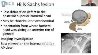 Your patient may have dislocated their shoulder what might you do [upl. by Kerrill]