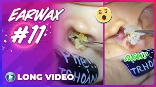 EP 11 Earwax ASMR  Series remove earwax after not cleaning for a long time [upl. by Tracee]