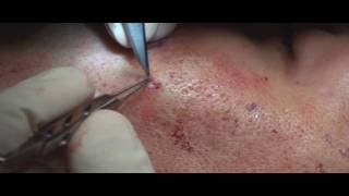 Acne Scar Revision Part 04 More Subcision Technique by Dr Young [upl. by Godfry240]