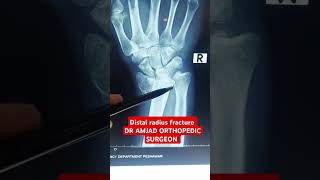 Distal radius fracture orthopedics doctor shortvideo [upl. by Vento69]