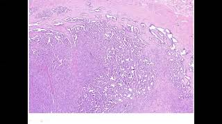 Papillary Renal Cell Carcinoma [upl. by Nossah]