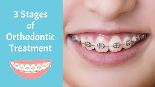 The 3 Stages of Orthodontic Treatment [upl. by Leandro]