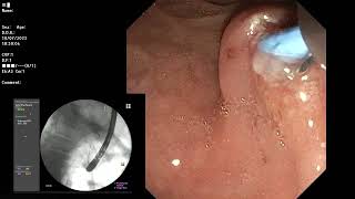 ERCP  Difficult CBD cannulation transpancreatic precutseptotomy with simple catheter cannulation [upl. by Parrish]