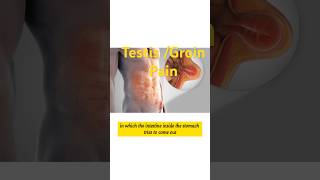 Reason for Repeated Testis  Groin pain [upl. by Ssitruc]