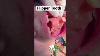 Flipper tooth 🦷😁 shorts viral teeth short [upl. by Sauer648]