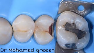 Rubber Dam Isolation for posterior teeth  multiple Isolation technique [upl. by Calida]