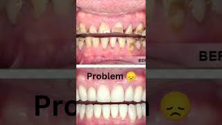 Fix your all Teeth and Gums problems by Prodentim shorts [upl. by Anirhtak]