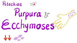 Petechiae Purpura and Ecchymoses [upl. by Sumahs267]