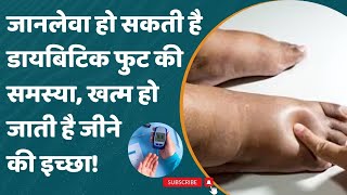 Diabetic Foot अक्सर बढ़ा रहता है Sugar Level कहीं कटाना न पड़ जाए पैर [upl. by Gard]